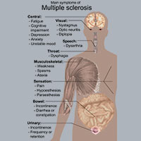 Multiple Sklerose und CBD