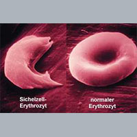 Sichelzellenanämie und CBD